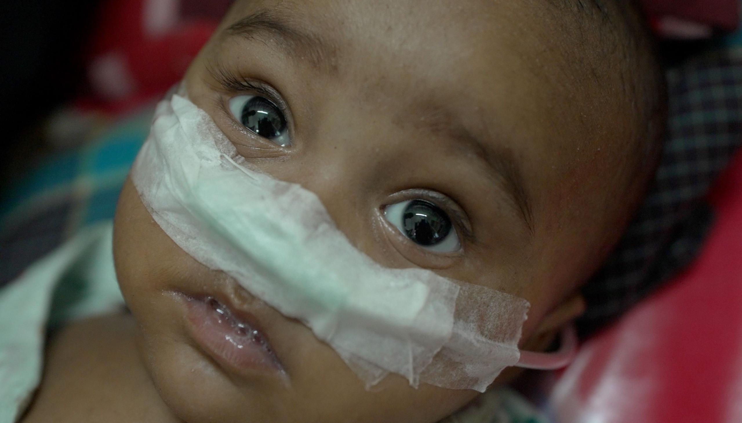 Bangladesh's Measles Surge Claims Hundreds of Children